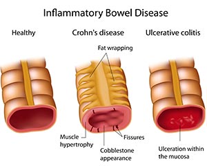 Inflammatory Bowel Disease