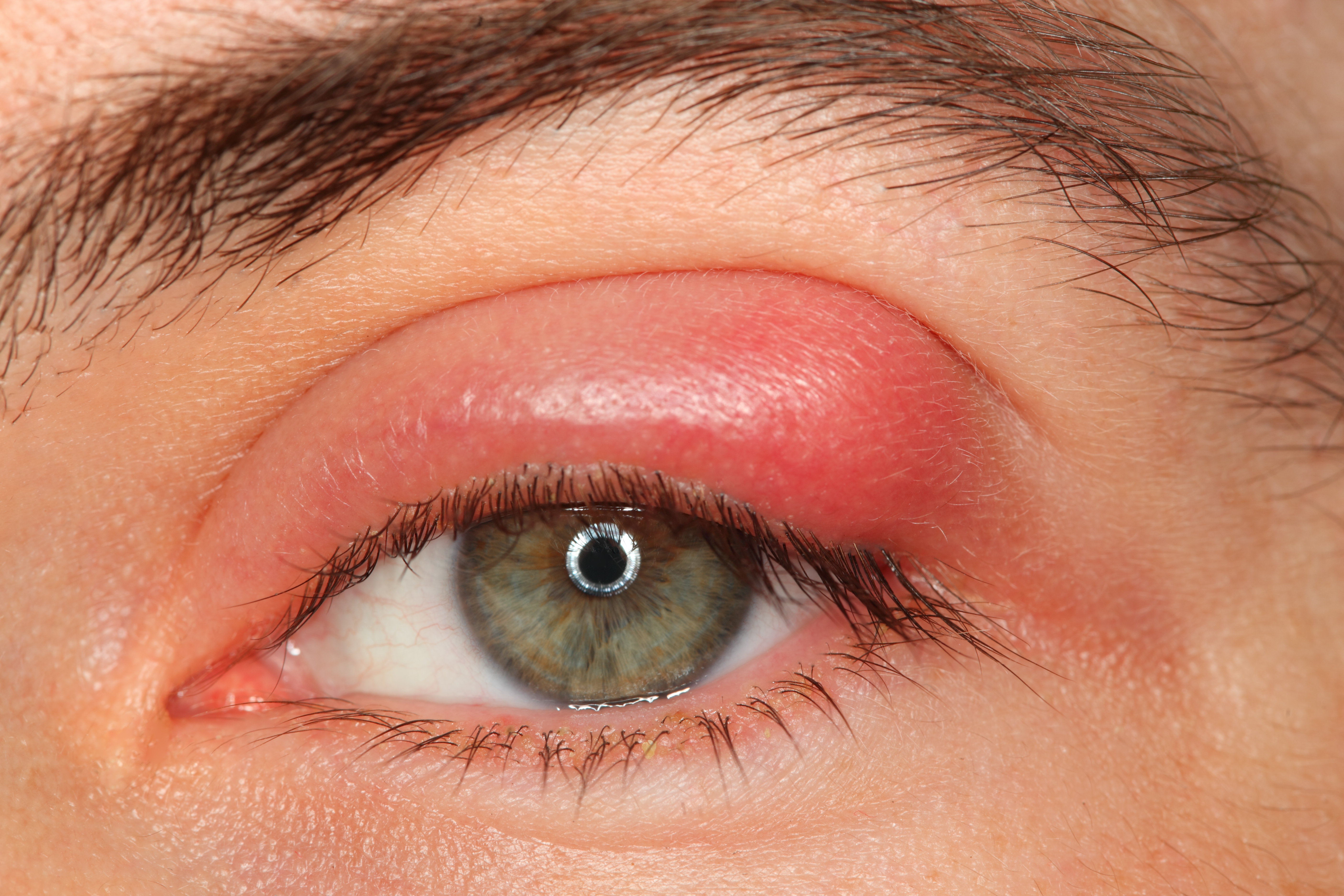 Chalazion
