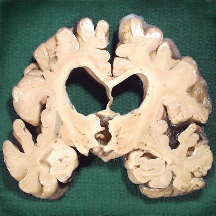 Alzheimerlı Beyin