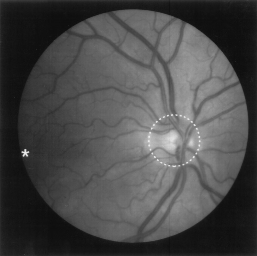 Retina Körlüğüne Çare Olabilecek Yeni Bir Kimyasal Bulundu!