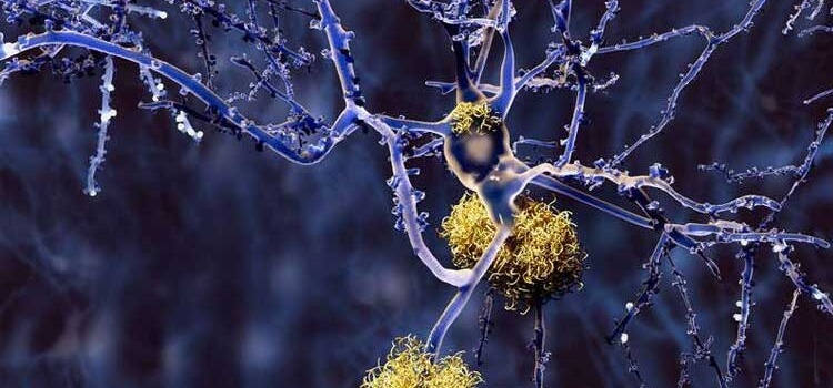 Alzheimer Tedavisinde Umut Verici Gelişme