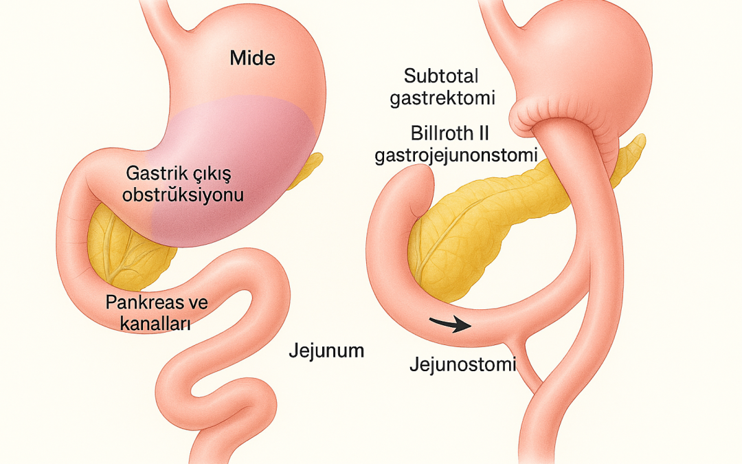 Gastrojejunostomi