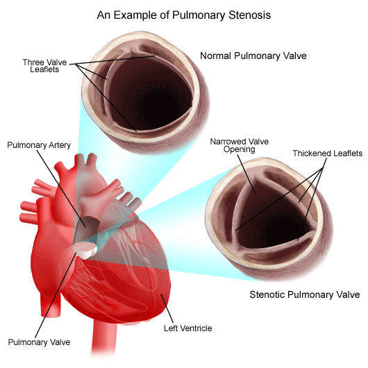Pulmoner Stenoz