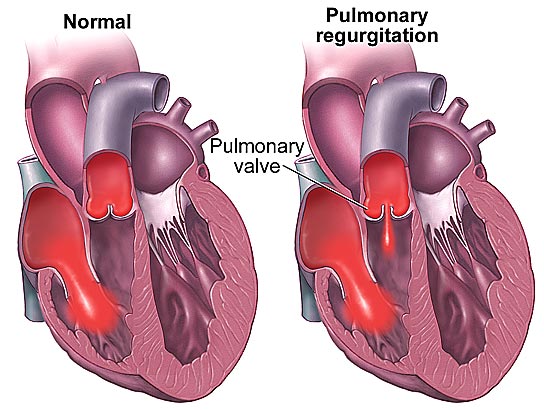 Pulmoner kapak yetmezliği (PKY)