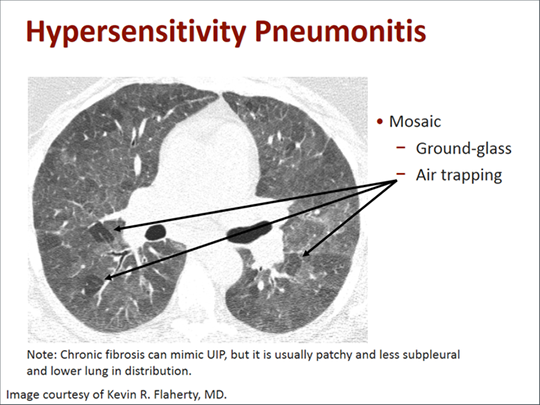Hipersensitivite pnömonisi