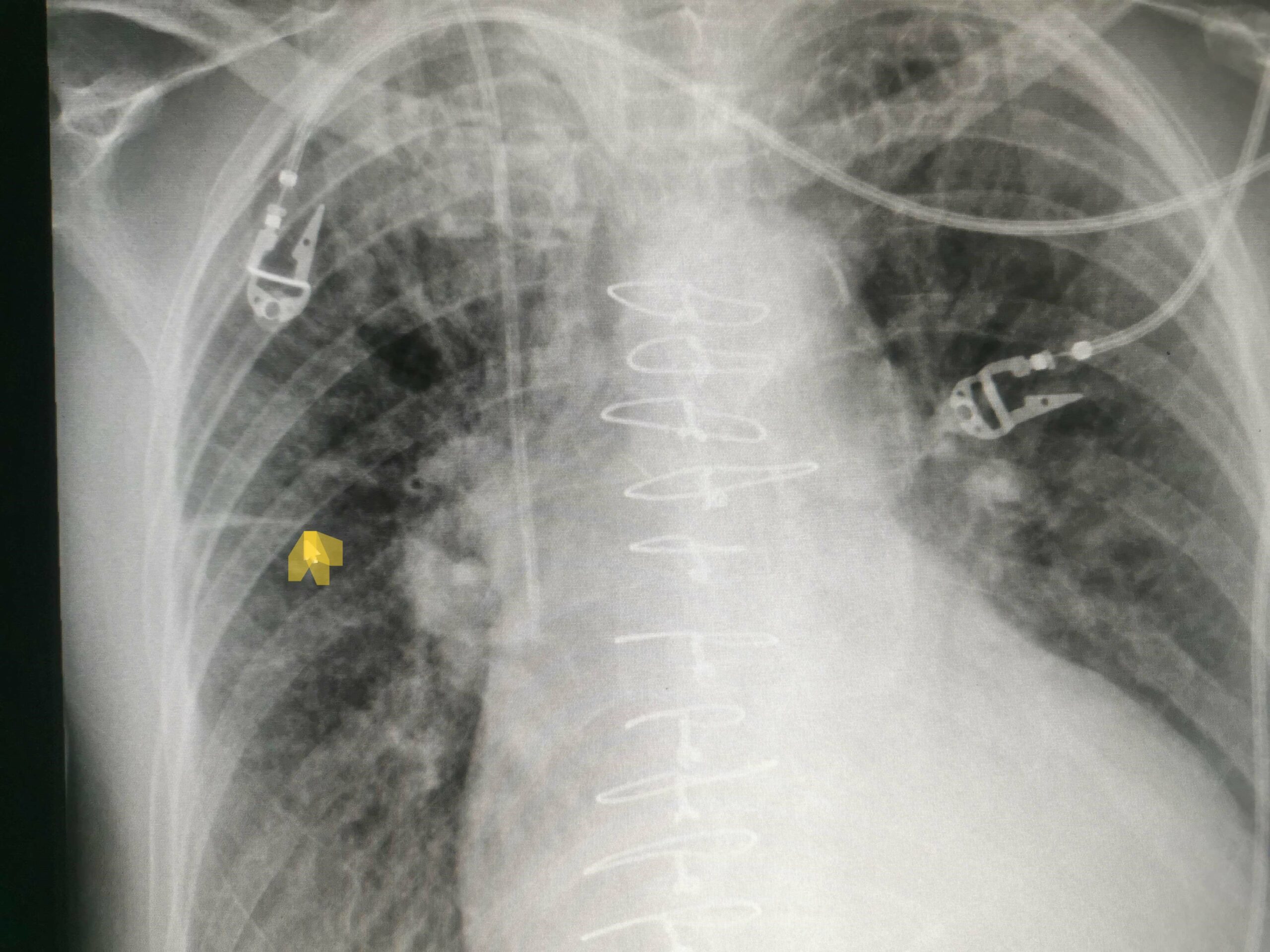 Atelectasis platealis