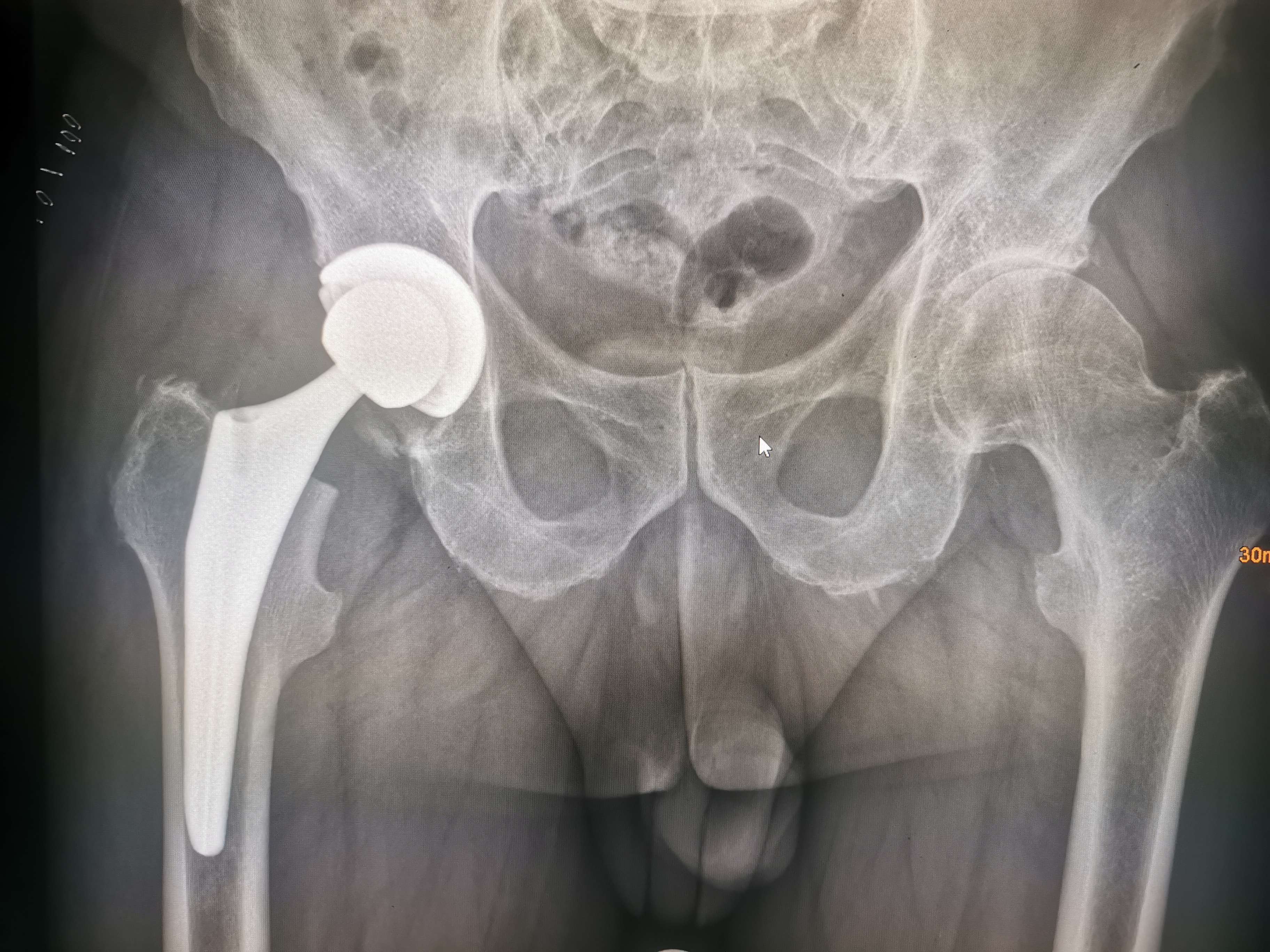 Total Kalça Artroplastisi